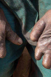 World Leprosy Day 2019: Expert Says Why It’s Dangerous To ‘Cure’ Leprosy With Alternative Medicine World Leprosy Day 2019: Expert Says Why It’s Dangerous To ‘Cure’ Leprosy With Alternative Medicine